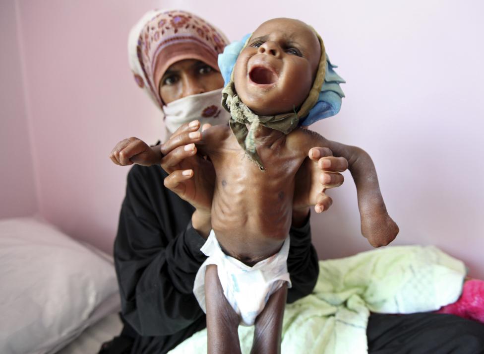  Merciless Saudi Aggression: Going Hungry in Yemen