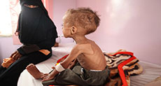 500,000 Children Facing Malnutrition in Yemen