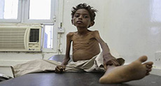 Yemen’s Children Starve as War Drags On!
