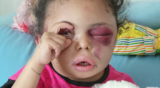 The 5-Year-Old Girl Who Opened the World’s Eyes to Yemen’s Plight
