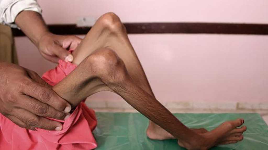 Saudi Arabia Forcing Millions into Starvation While World Obsesses Over Murdered Journalist