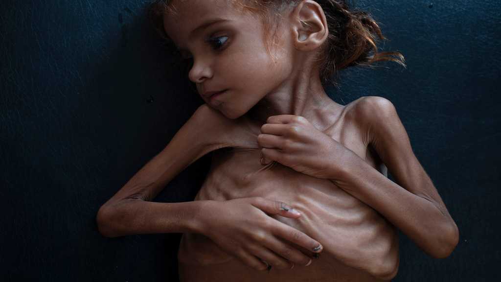 Yemen Girl Who Turned World’s Eyes to Famine Is Dead