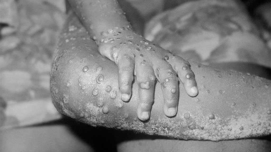 Rare Monkeypox Virus Outbreak Sets Europe, US on Alert