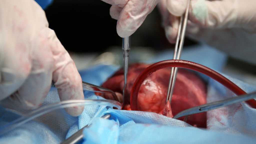 Iran Leads Organ Donation in West Asia, Performs All Types of Transplants