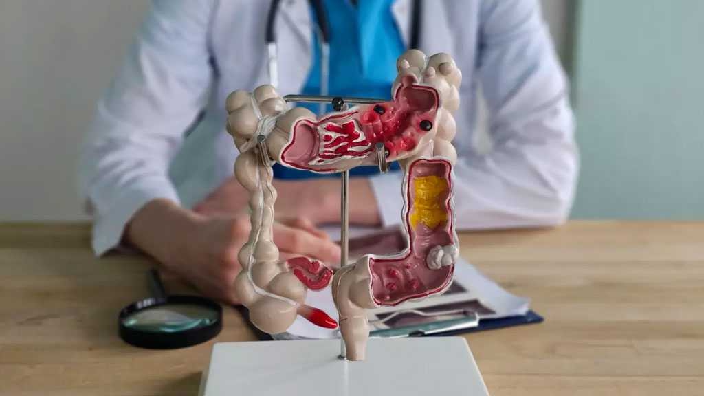 Colon Cancer Now Top Cancer Killer in Americans Under 50