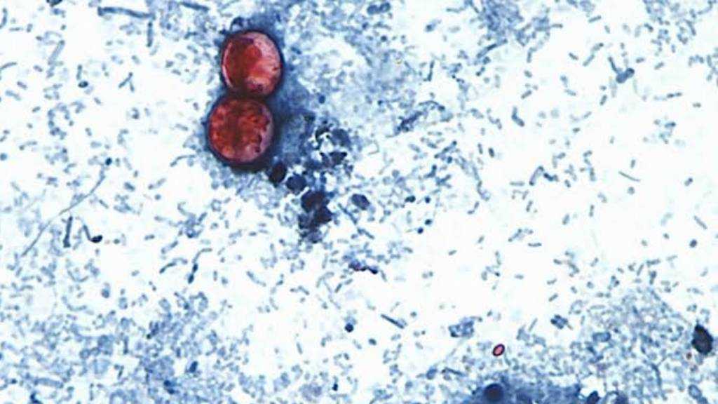 First US Deaths Confirmed in Parasite Outbreak